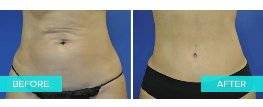 LIV-Plastic-Surgery_Tummy-Tuck_Case-3