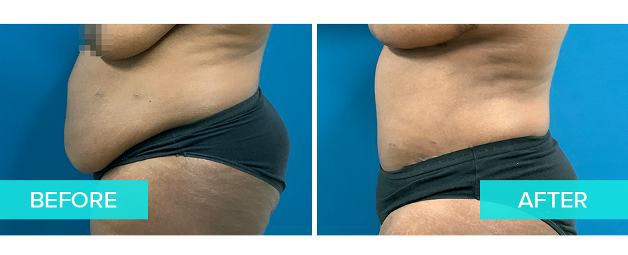 Tummy Tuck Case 1