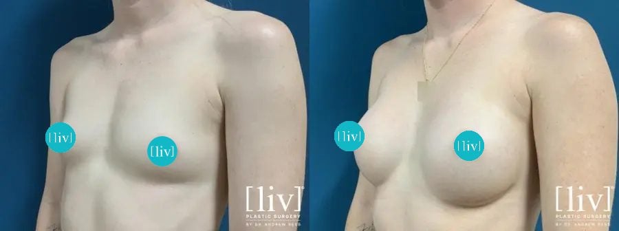 Breast Augmentation Recovery Week by Week